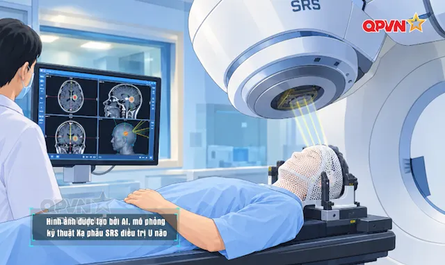 Hiệu quả của xạ trị, xạ phẫu trong điều trị u não phức tạp